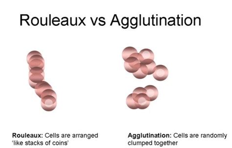 rouleaux formation vs agglutination.